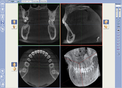 ProMax3D锥形束口腔断层成像系统